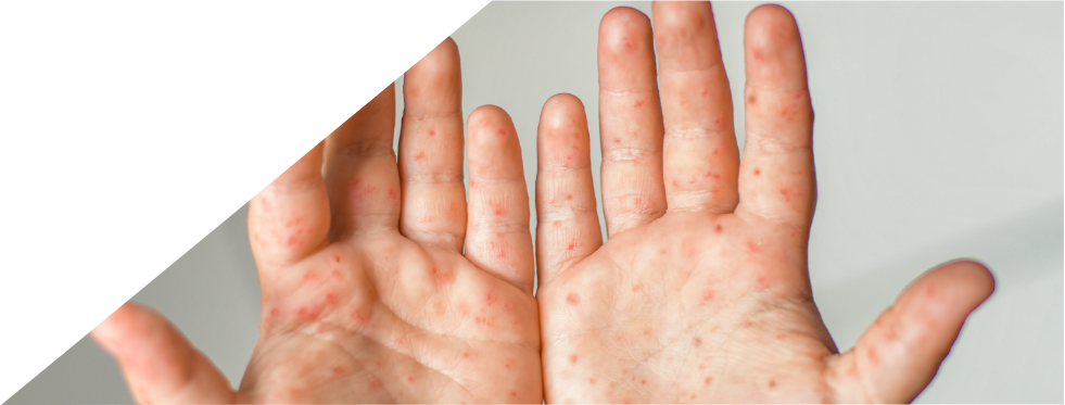 Mãos com sintoma de pés mãos boca