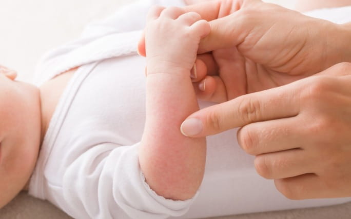 Braço de um bebé deitado seguro por mãos de adulto que mostram uma alergia infantil na pele