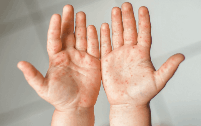 Mãos de uma criança com as bolhas típicas da síndrome mão-pé-boca.